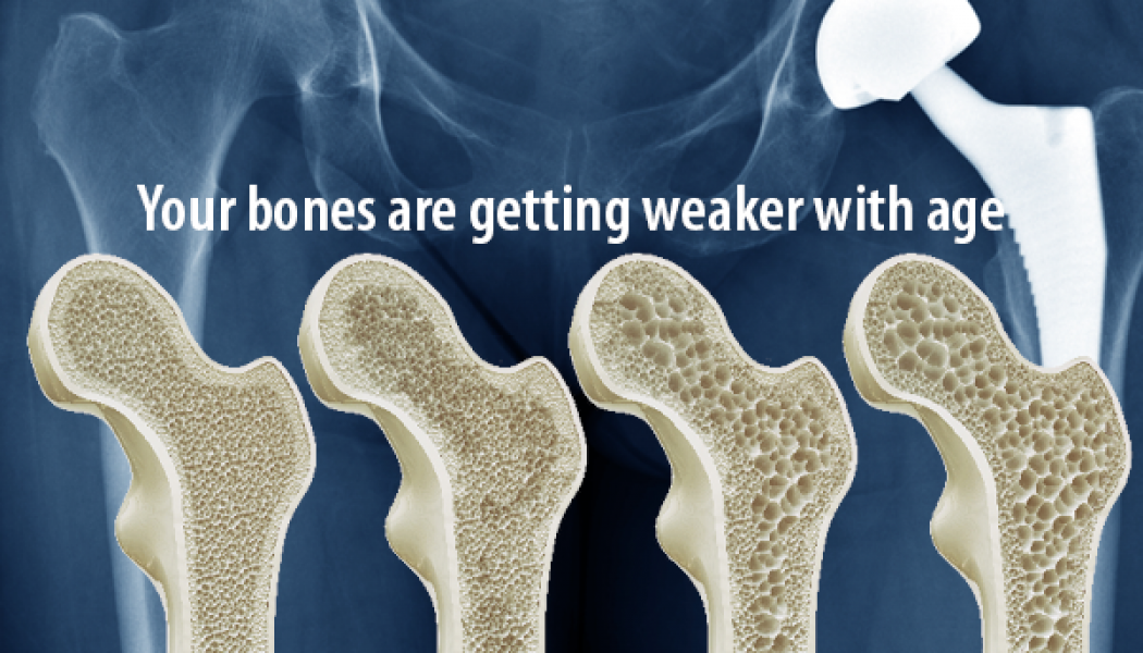 SPECIAL OFFER – Densitometry – Check Your Bone Health