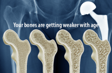 SPECIAL OFFER – Densitometry – Check Your Bone Health